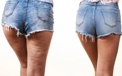 Ondas de choque para eliminar la celulitis